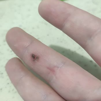 Patlayan Saç Kurutma Makinesi: Yanık Ve Korku Dolu Anlar