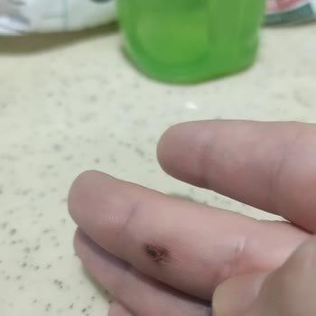 Patlayan Saç Kurutma Makinesi: Yanık Ve Korku Dolu Anlar