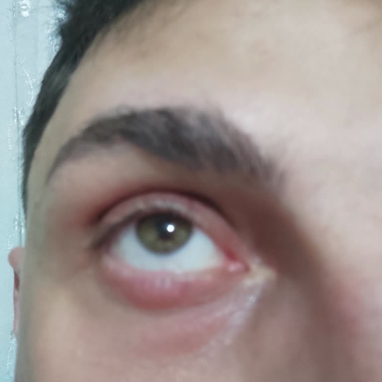 Göz Altı Kremi Şişlik Ve Ağrı Sorunu