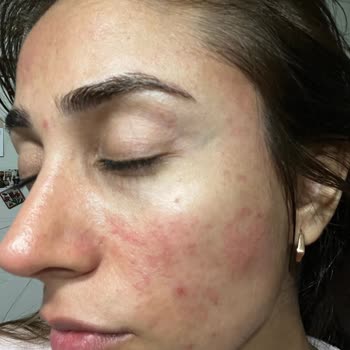La Roche Posay Ürünü İle Şiddetli Yanma Ve Kızarıklık