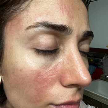 La Roche Posay Ürünü İle Şiddetli Yanma Ve Kızarıklık