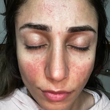 La Roche Posay Ürünü İle Şiddetli Yanma Ve Kızarıklık