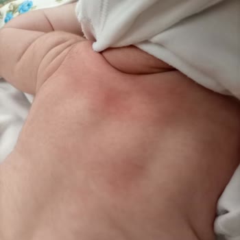 Bebeğimin Cildinde Kızarıklık Ve Kabarmaya Sebep Olan Ürün