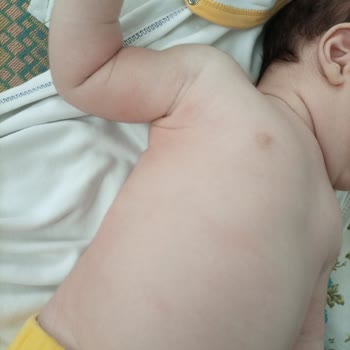 Bebeğimin Cildinde Kızarıklık Ve Kabarmaya Sebep Olan Ürün