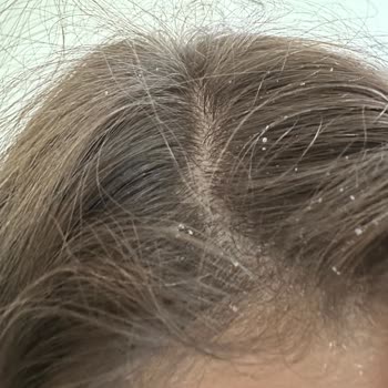 Hepsiburada OGX Biotin Collagen Şampuan İle Yaşadığım Kaşıntı Ve Kepek Kabusu