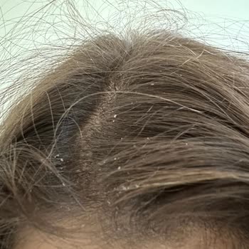 Hepsiburada OGX Biotin Collagen Şampuan İle Yaşadığım Kaşıntı Ve Kepek Kabusu