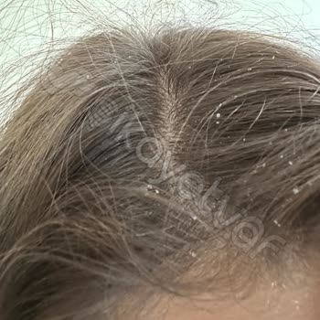 Saldoscare Sağlığımı Bozan Şampuanla Gelen Kepek Ve Kaşıntı Kabusu