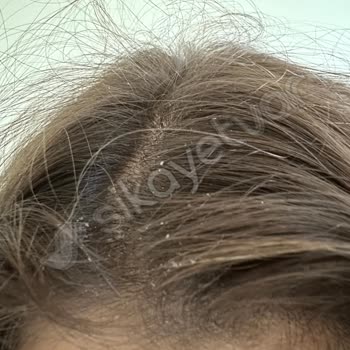 Saldoscare Sağlığımı Bozan Şampuanla Gelen Kepek Ve Kaşıntı Kabusu