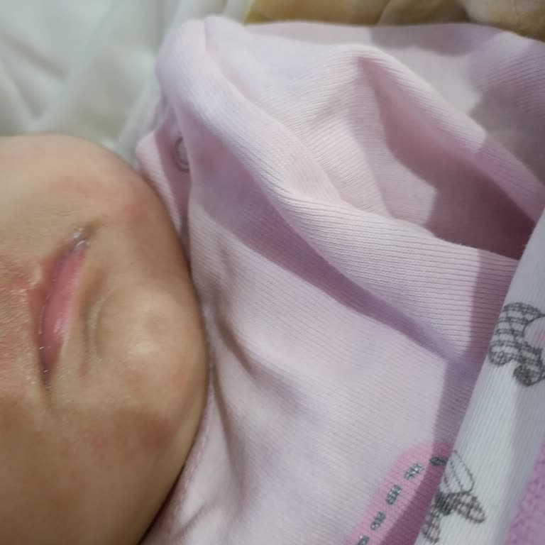 Mustela Bebek Şampuanı Kızarıklık Sorunu