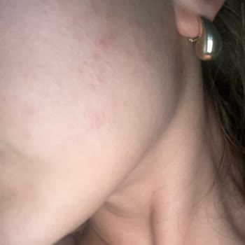 Estee Lauder Gece Serumu Cilt Sorunlarına Yol Açtı