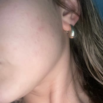 Estee Lauder Gece Serumu Cilt Sorunlarına Yol Açtı