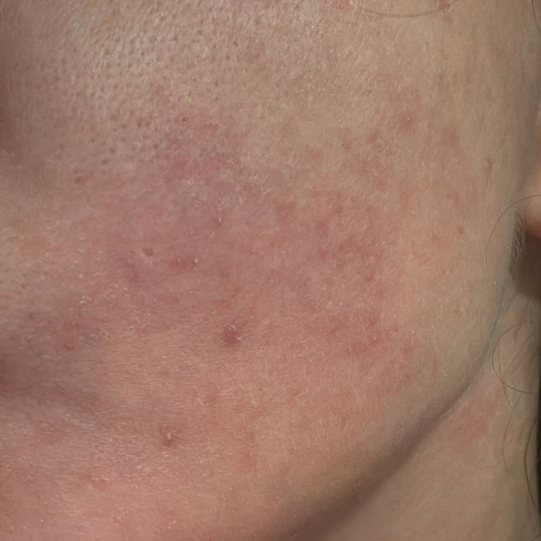 Maruderm Yüz Yıkama Jeli: Ciltte Yanma Ve Kaşıntı Problemi