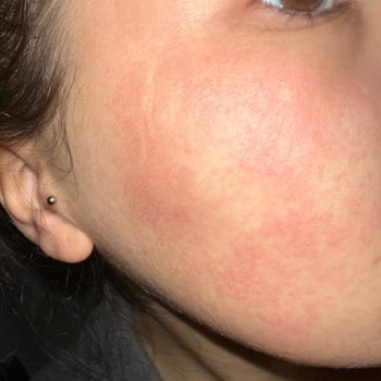 Bee Beauty Pirinç Kağıt Yüz Maskesi Alerjik Reaksiyona Sebep Oldu