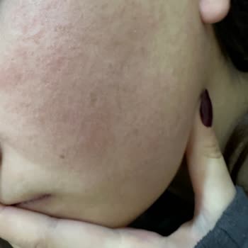 Bee Beauty Pirinç Kağıt Yüz Maskesi Alerjik Reaksiyona Sebep Oldu