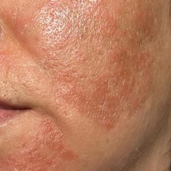 Avis Vip Eryaman Güzellik Salonu Uygulamalarında Hayal Kırıklığı Ve Sağlık Sorunları