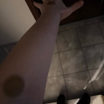 Hastanede Damar Yolu Krizi Ve Şişirilmiş Fatura Şoku