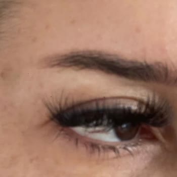 Estesante Clinic Yaşanan Botox Mağduriyeti