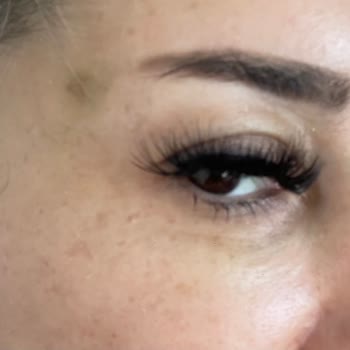 Estesante Clinic Yaşanan Botox Mağduriyeti