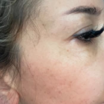 Estesante Clinic Yaşanan Botox Mağduriyeti