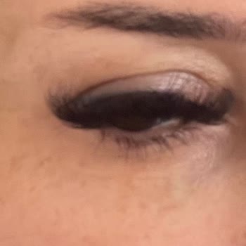 Estesante Clinic Yaşanan Botox Mağduriyeti