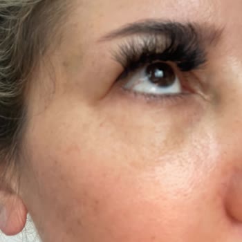 Estesante Clinic Yaşanan Botox Mağduriyeti