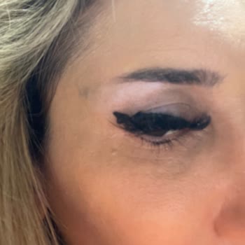 Estesante Clinic Yaşanan Botox Mağduriyeti