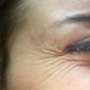 Estesante Clinic Yaşanan Botox Mağduriyeti