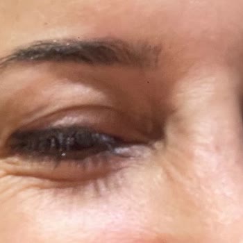 Estesante Clinic Yaşanan Botox Mağduriyeti