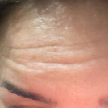 Estesante Clinic Yaşanan Botox Mağduriyeti