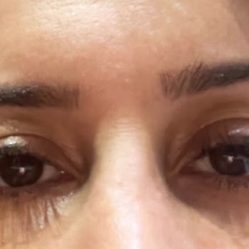 Estesante Clinic Yaşanan Botox Mağduriyeti