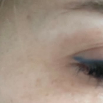 Estesante Clinic Yaşanan Botox Mağduriyeti