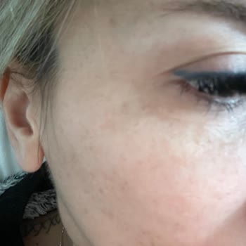 Estesante Clinic Yaşanan Botox Mağduriyeti