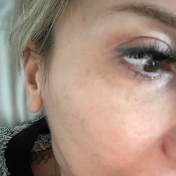 Estesante Clinic Yaşanan Botox Mağduriyeti