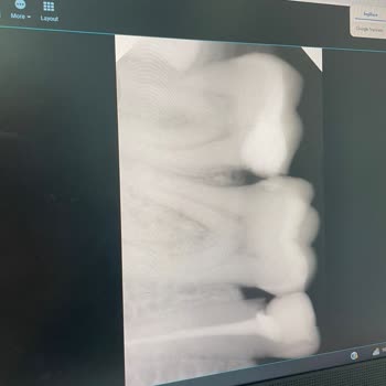 DT. Mustafa Yılmaz (Ymdentist) Özensiz Diş Dolgusu Yapımı Ve Mağduriyet!