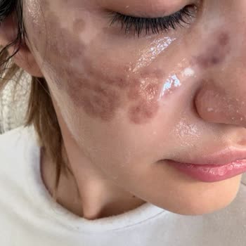 Dermatolog Dr. Melda Özekinci Yüzümde 20 Gündür Yanık Lekesiyle Geziyorum