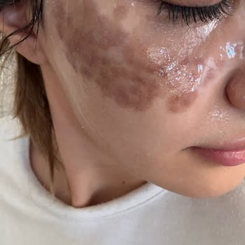 Dermatolog Dr. Melda Özekinci Yüzümde 20 Gündür Yanık Lekesiyle Geziyorum