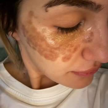 Dermatolog Dr. Melda Özekinci Yüzümde 20 Gündür Yanık Lekesiyle Geziyorum