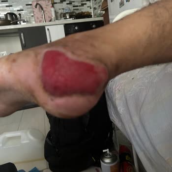 Ameliyat Sonrası Yetersiz Bakım Ve İletişim Sorunları