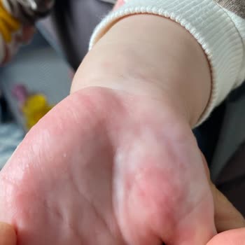 Bebek Sabununda Alerji Problemi