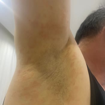 Rexona Roll-On me causó alergia severa en un mes