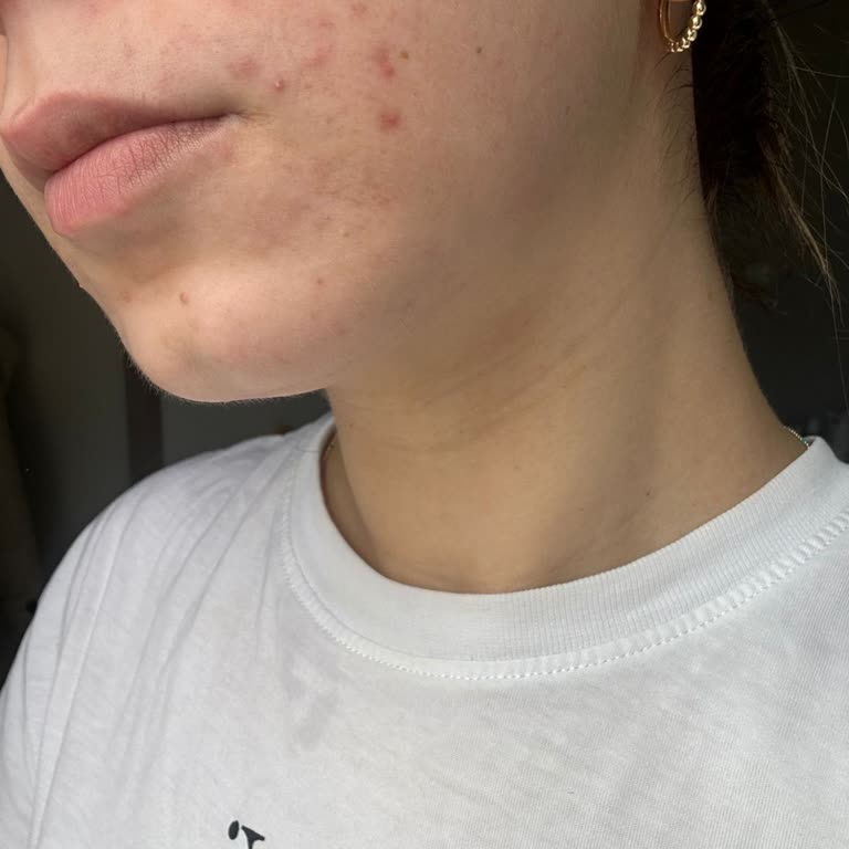 Altın İğne Ve Somon DNA İşlemi Sonrası Kalıcı İzler