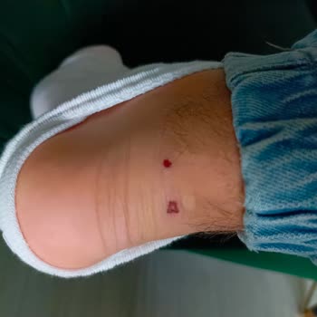 Krampon Sağ Ayağımda Yara Yapıyor