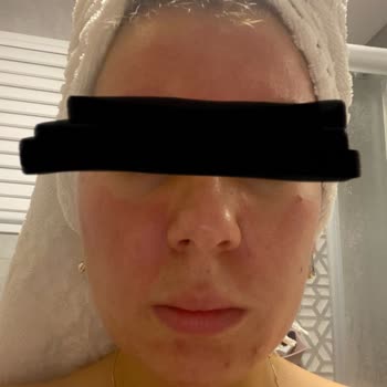 Yves Rocher Ürünleri Cildimde Sorun Yarattı!