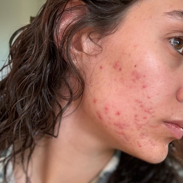 Bioderma Yüz Yıkama Jeli Alerji Ve Sivilce Sorunu