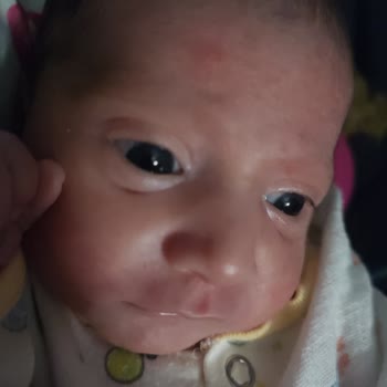 Bebek Losyonu Ciltte Tahrişe Neden Oldu