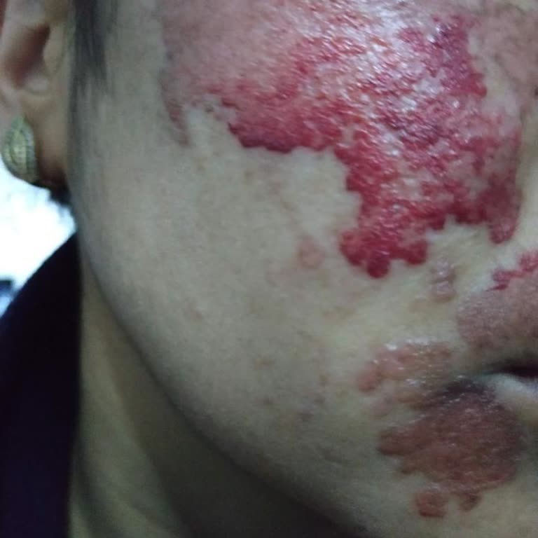 Duru Güzellik Merkezi | Karaman Yüzümdeki Lekeleri Geçireceğini Söyleyerek Yüzümü Yaktı!