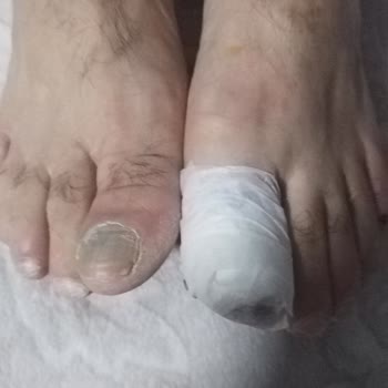 Ayakkabı Kullanımı Sonrası Sağlık Sorunları