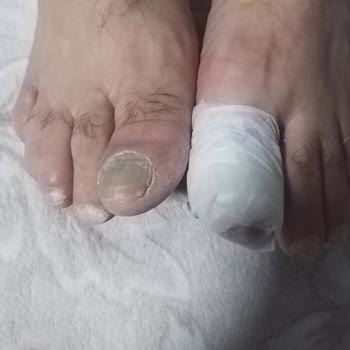 Ayakkabı Kullanımı Sonrası Sağlık Sorunları