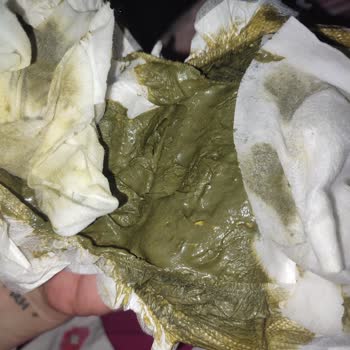 Bebeğimde Aptamil Kullanımı Sonrası Sorunlar