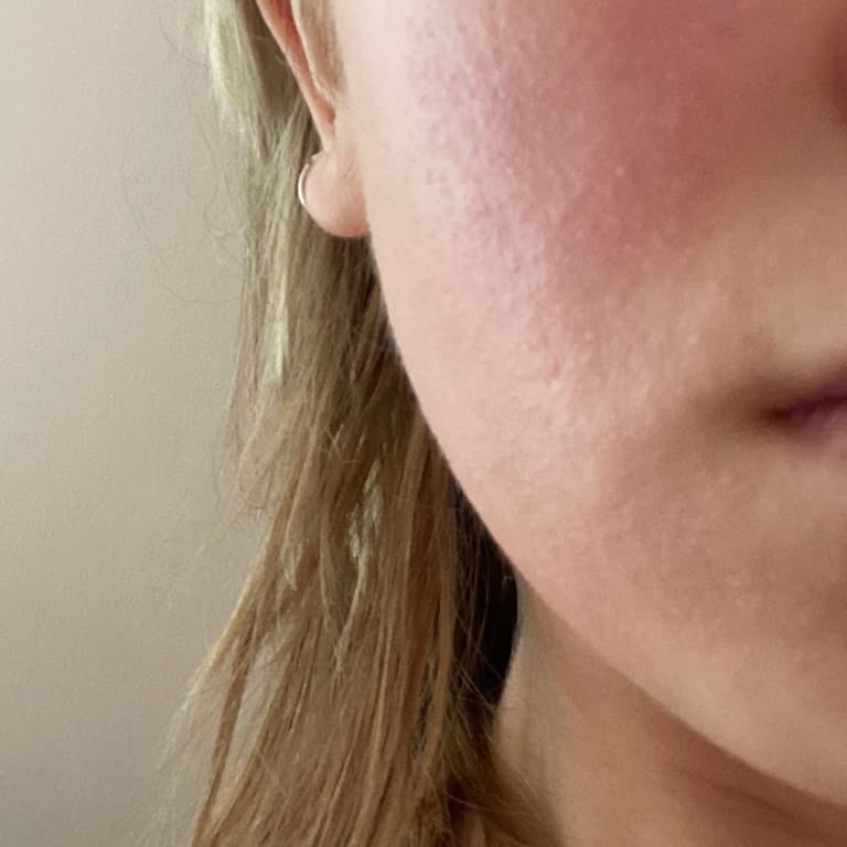 Yves Rocher Deneme Boy Ürün Cilt Sorunlarına Yol Açtı